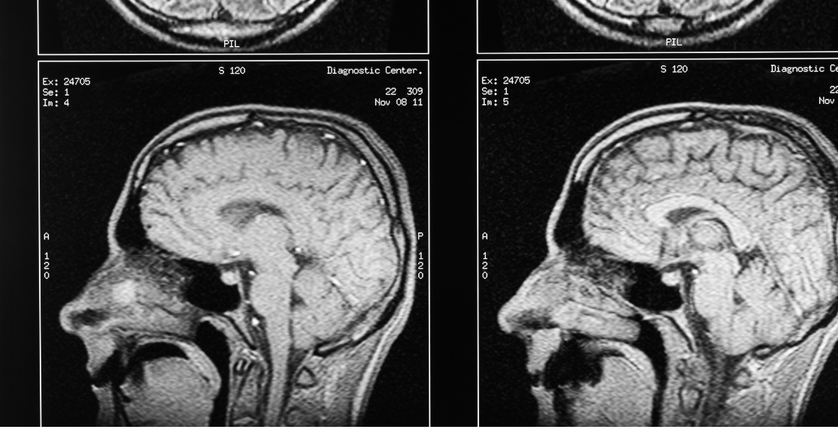 In what ways do neurosurgeons treat traumatic brain injuries?