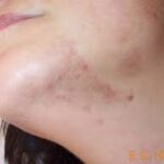 Diffuse pigmentation